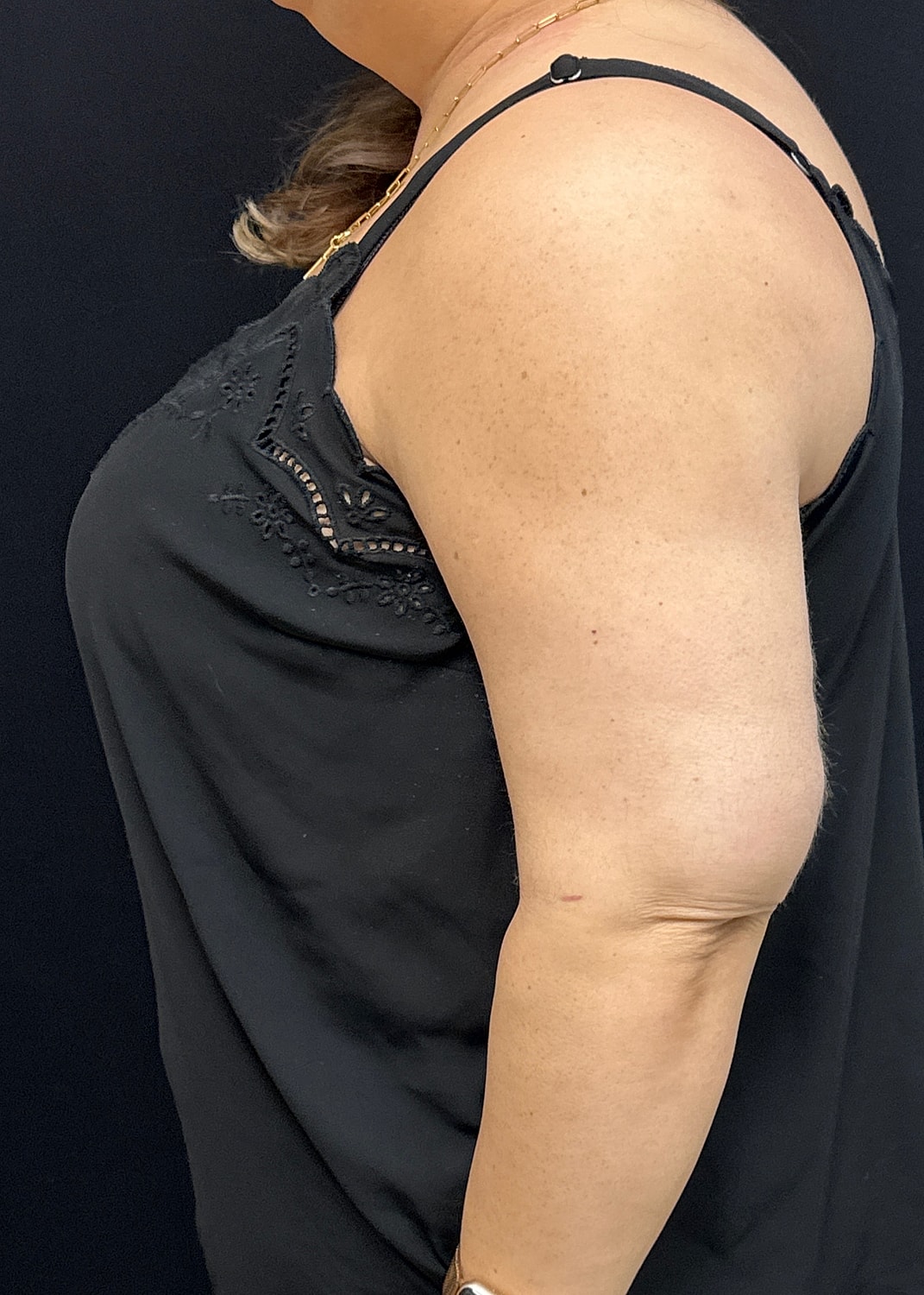 Arm Lift Before & After