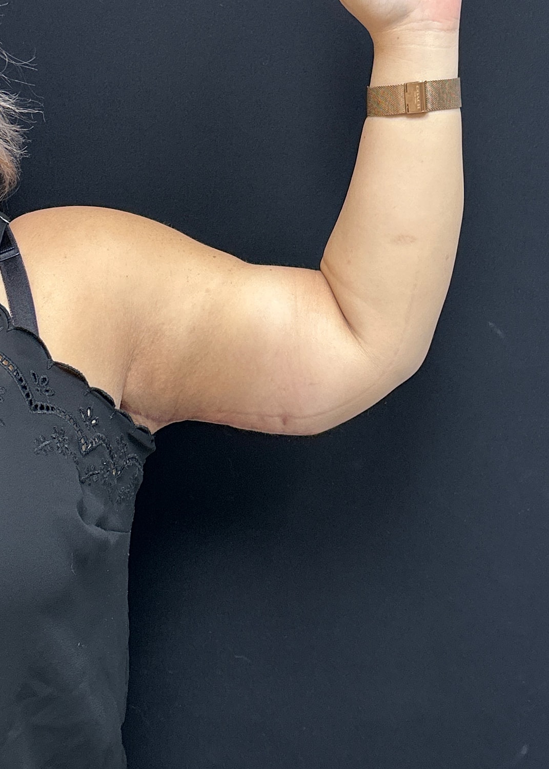 Arm Lift Before & After