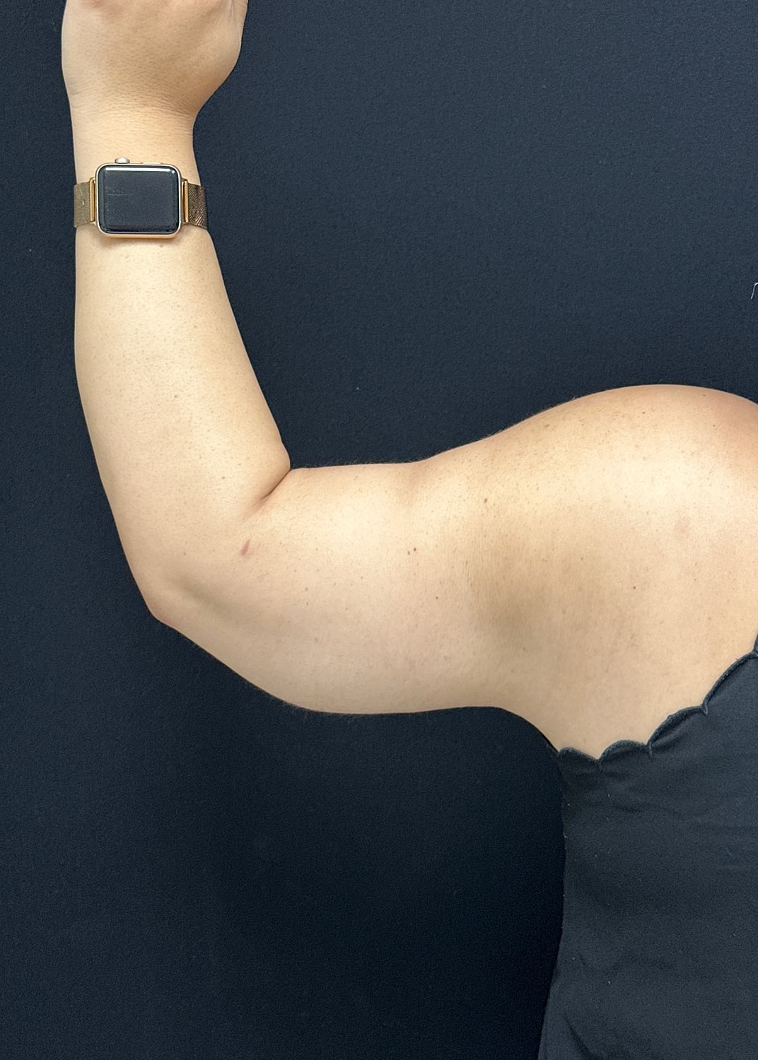 Arm Lift Before & After