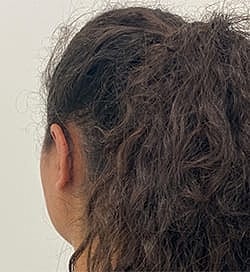 Otoplasty Before & After