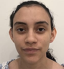 Otoplasty Before & After