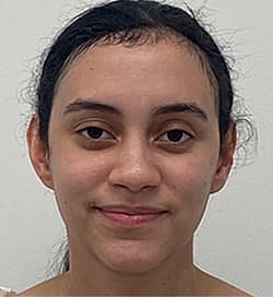 Otoplasty Before & After