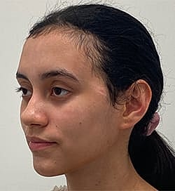 Otoplasty Before & After