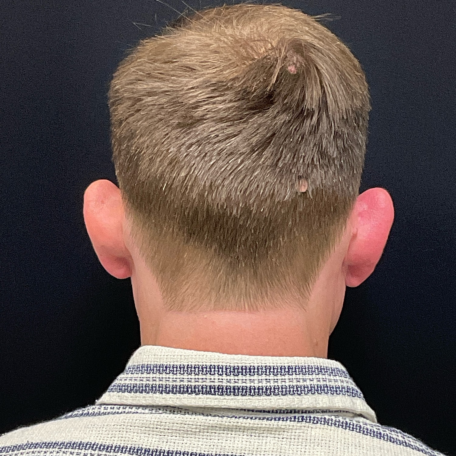 Otoplasty Before & After