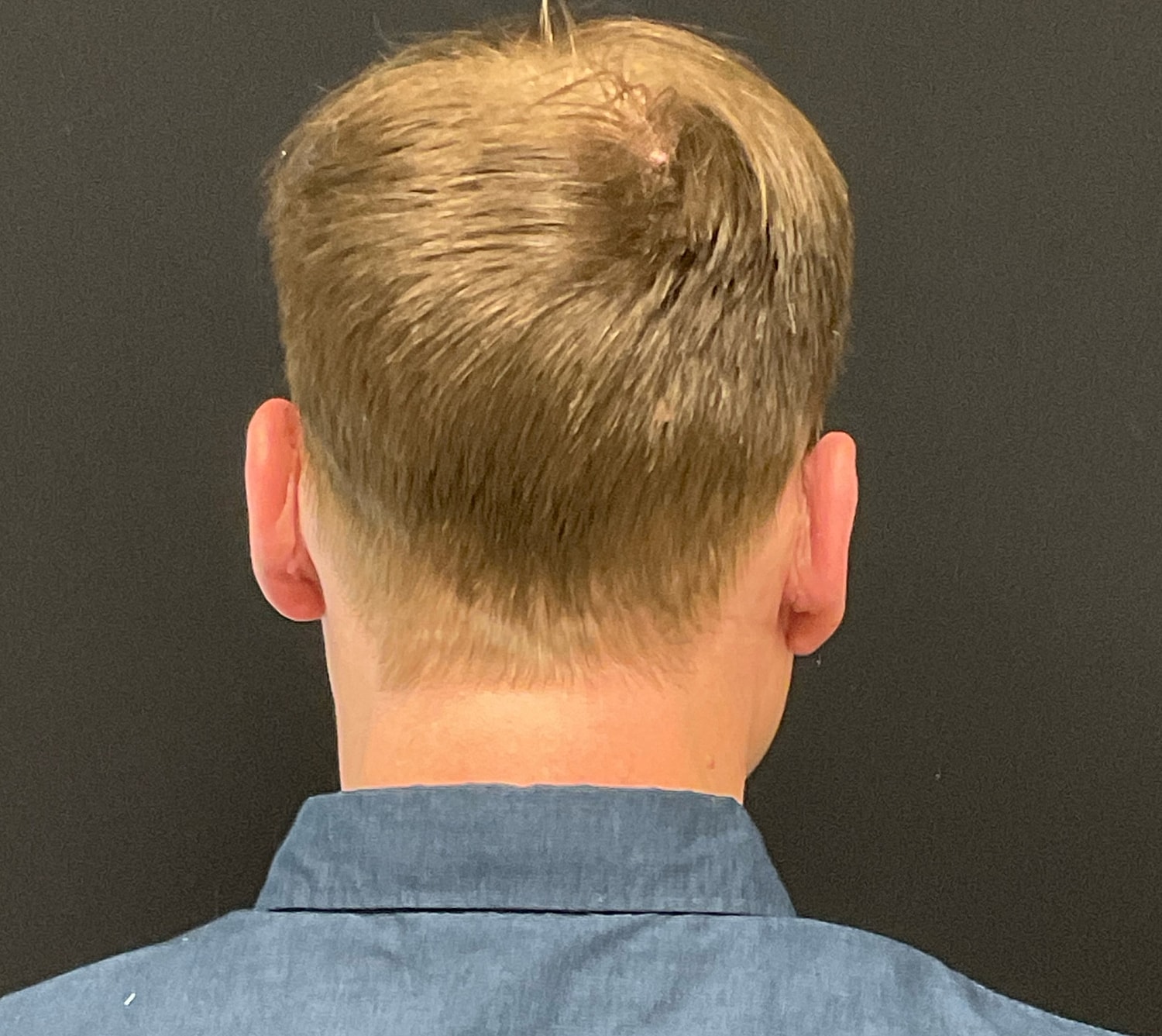 Otoplasty Before & After