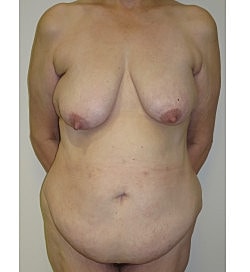 Mommy Makeover Before & After