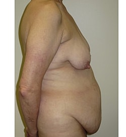 Mommy Makeover Before & After