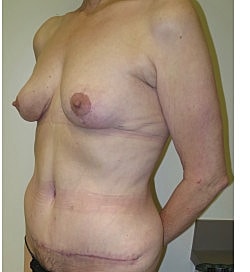 Mommy Makeover Before & After