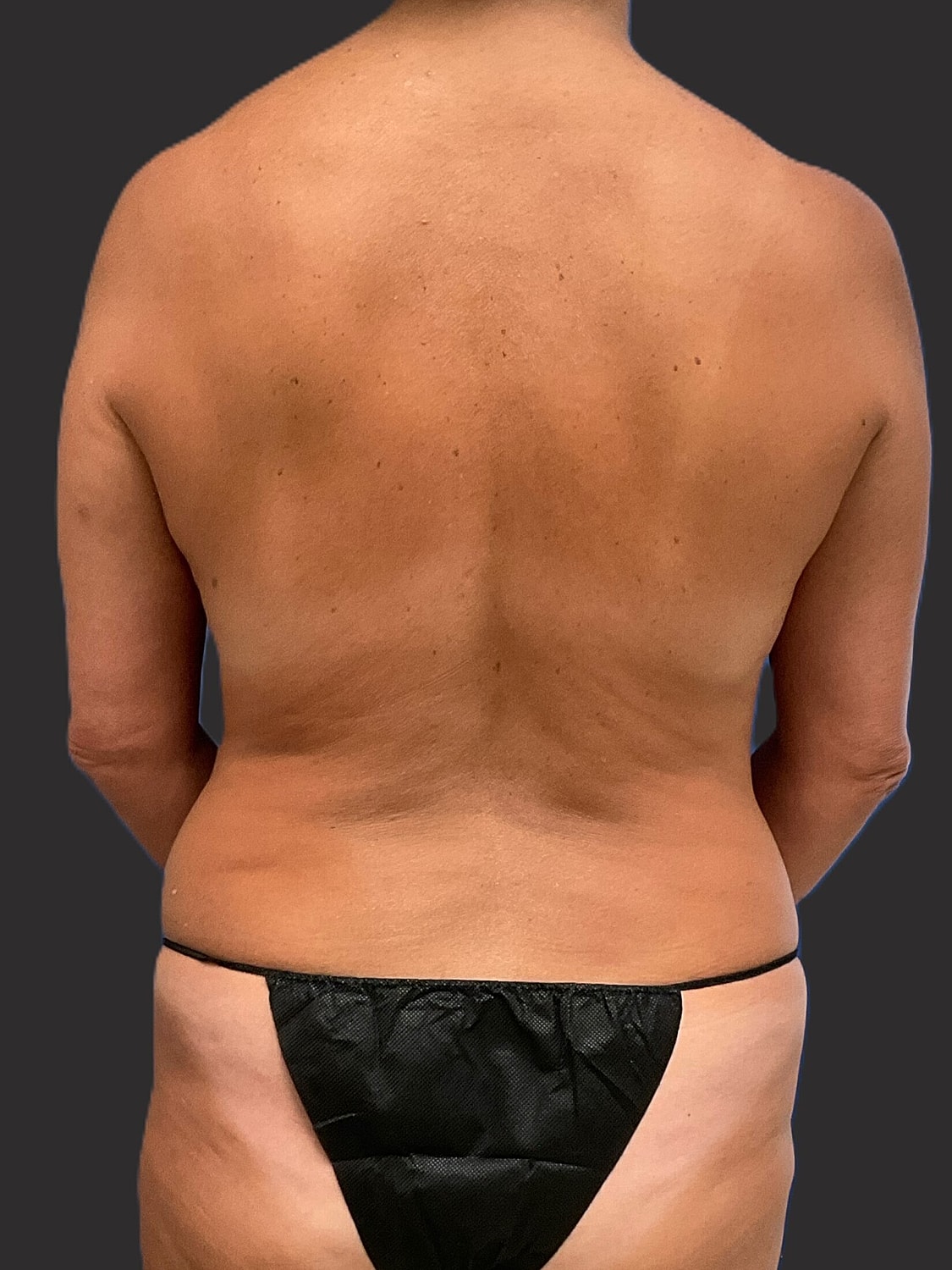 Mommy Makeover Before & After