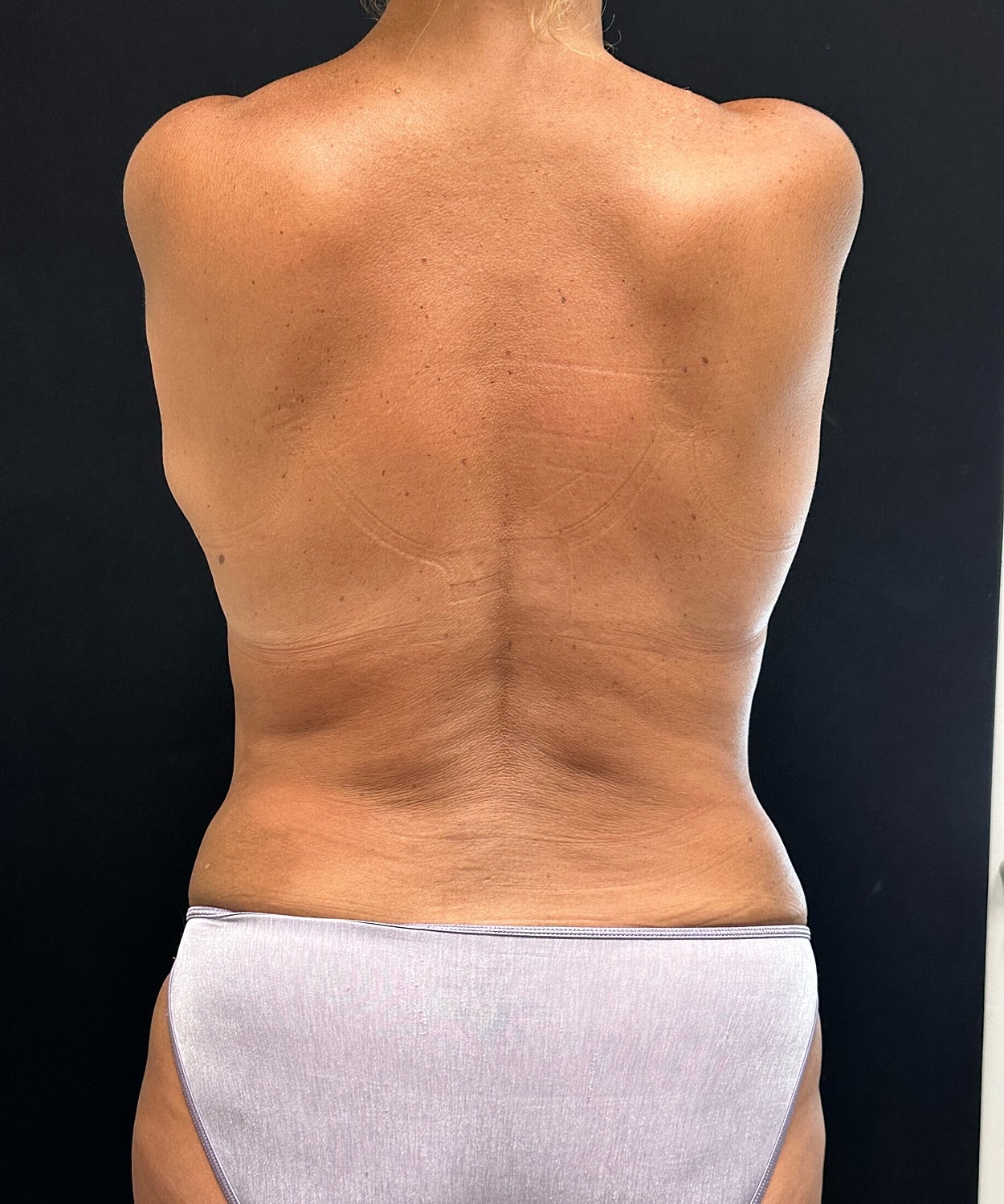 Mommy Makeover Before & After