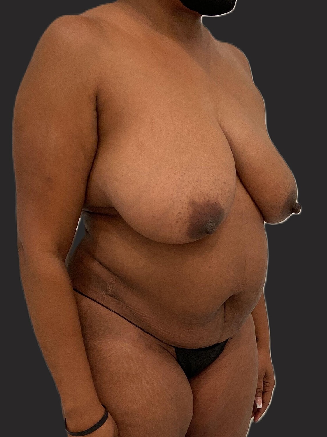 Mommy Makeover Before & After