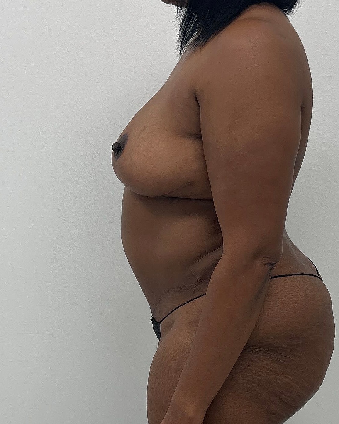 Mommy Makeover Before & After