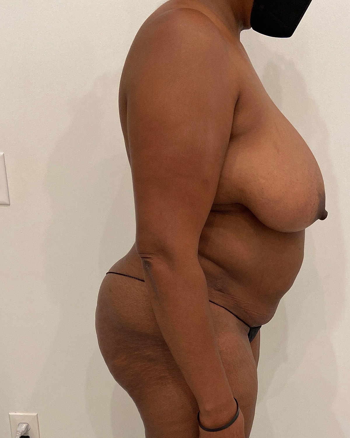 Mommy Makeover Before & After