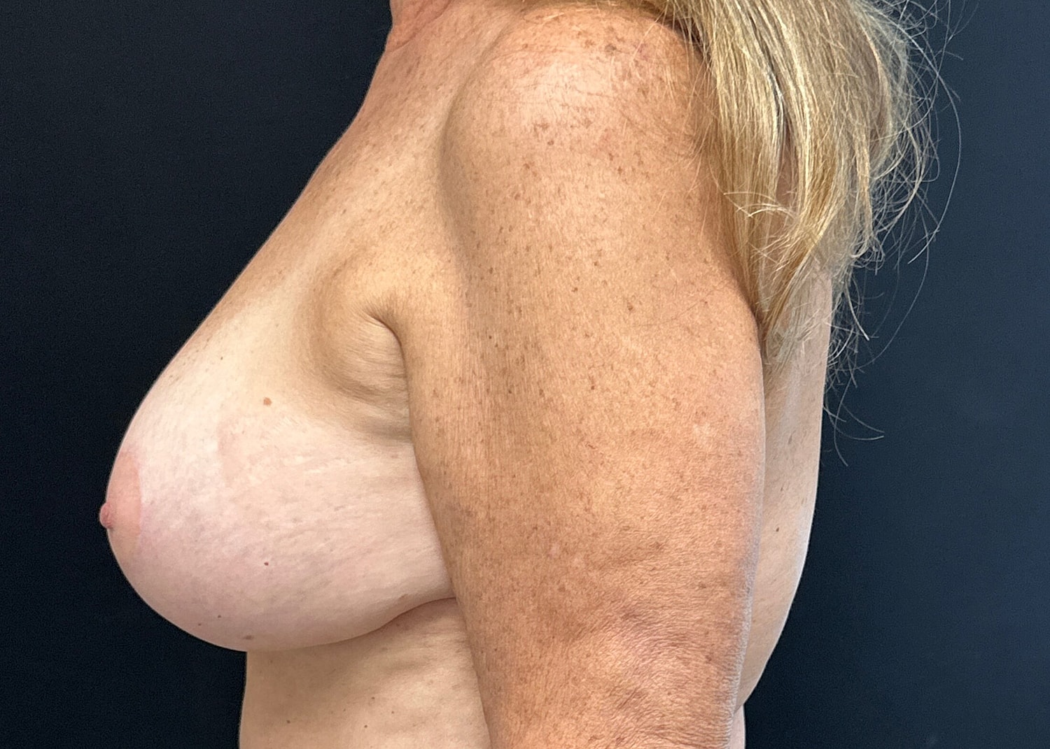 Breast Lift With Implant Before & After