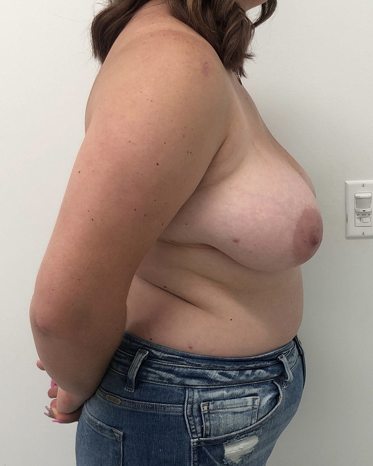 Breast Lift With Implant Before & After