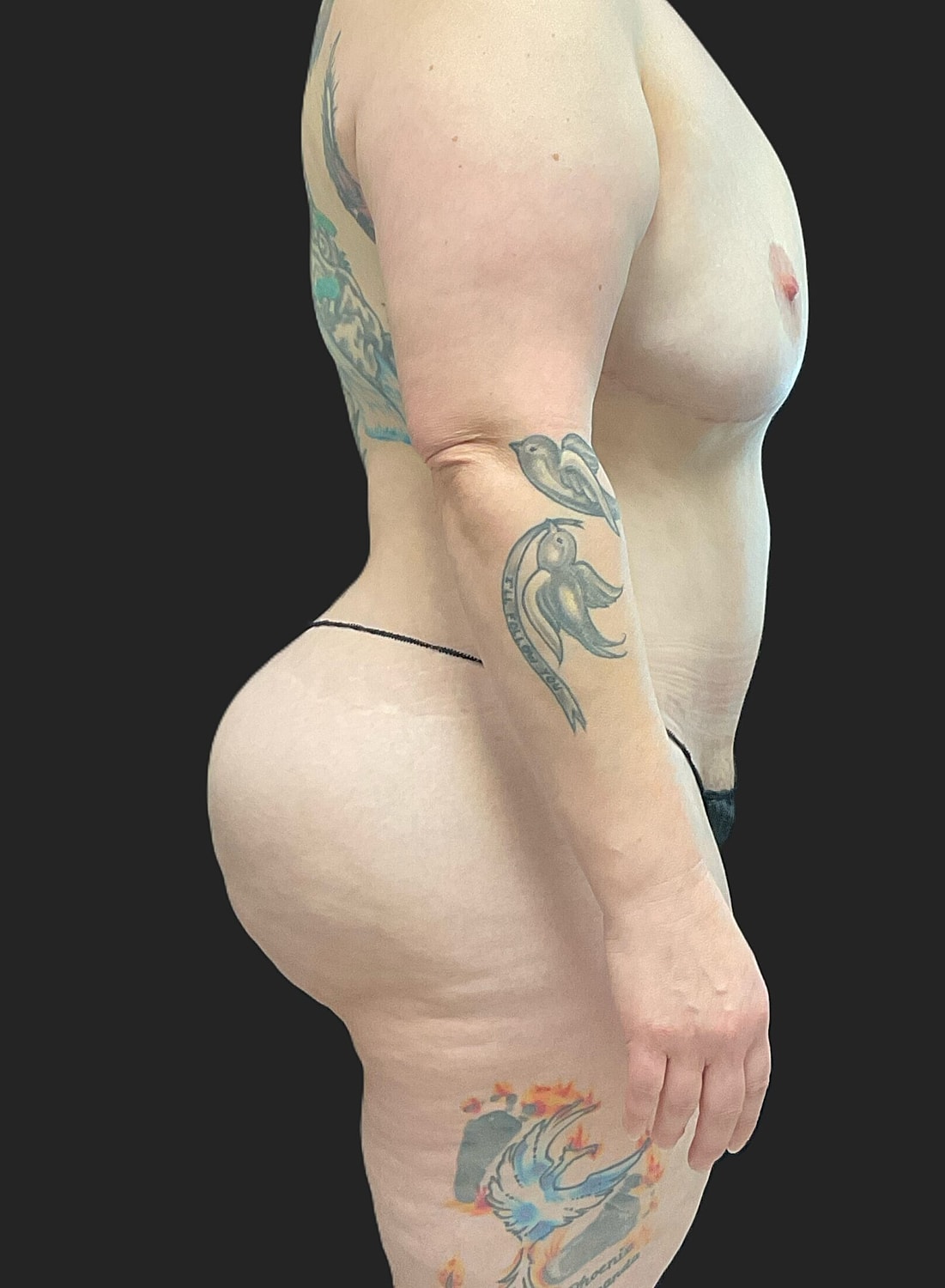 Brazilian Butt Lift Revision Before & After