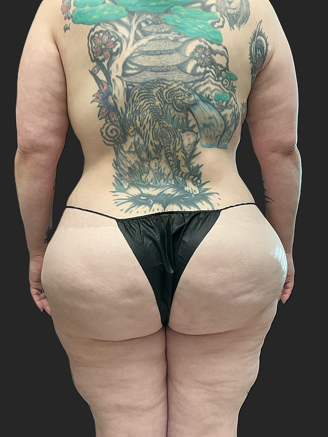 Brazilian Butt Lift Revision Before & After