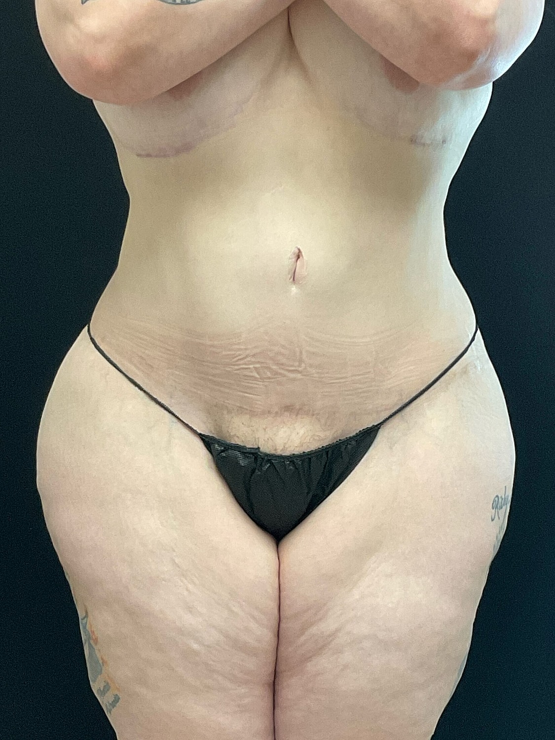 Brazilian Butt Lift Revision Before & After