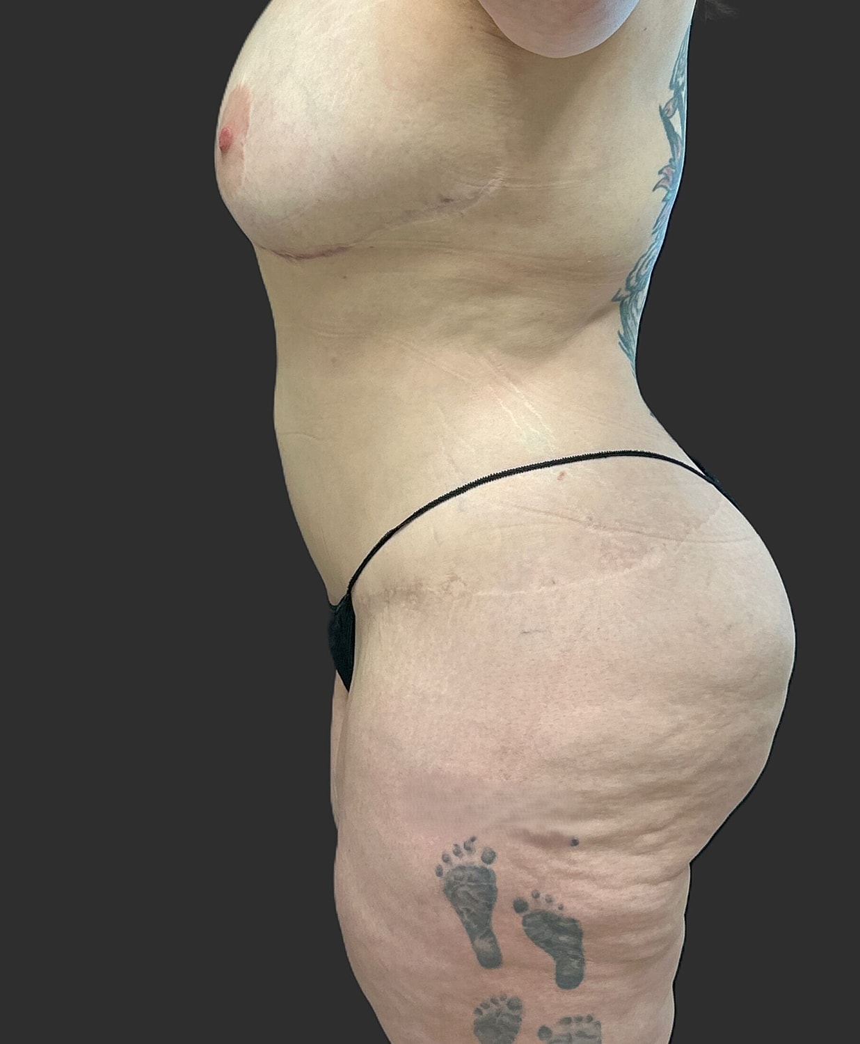 Brazilian Butt Lift Revision Before & After