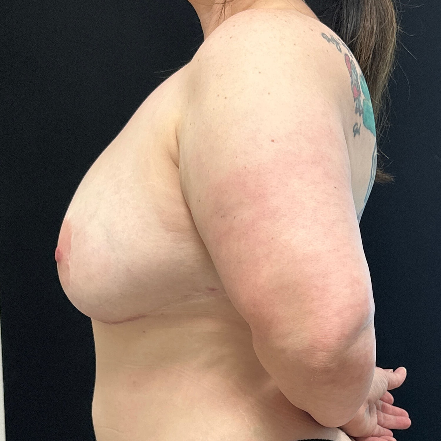 Breast Augmentation Fat Transfer Before & After