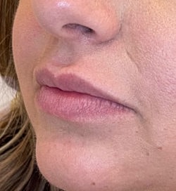 Lip Filler Before & After