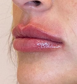 Lip Filler Before & After