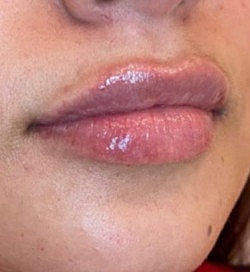 Lip Filler Before & After