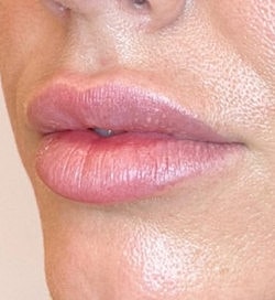 Lip Filler Before & After
