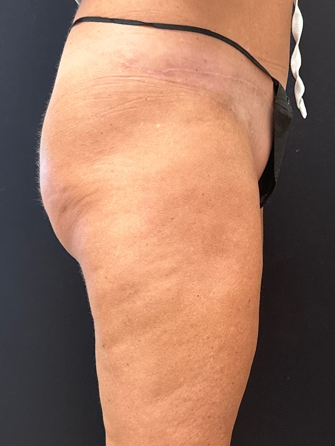 Aveli Cellulite Reduction Before & After