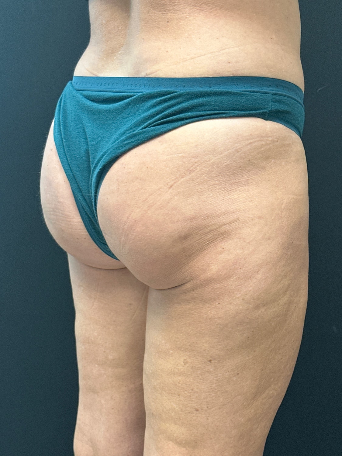 Aveli Cellulite Reduction Before & After