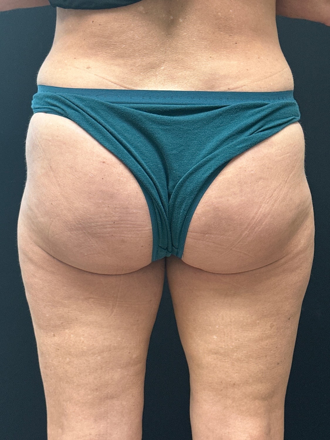 Aveli Cellulite Reduction Before & After