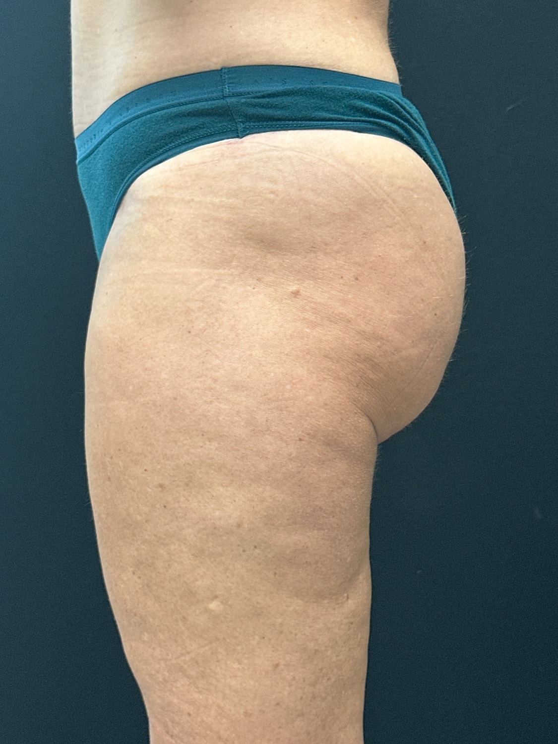 Aveli Cellulite Reduction Before & After
