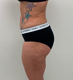 Liposuction Before & After