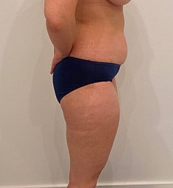 Liposuction Before & After