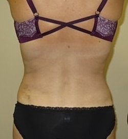 Liposuction Before & After